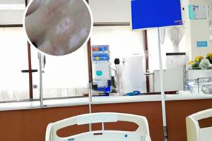 皮膚鏡下白斑的圖片分析